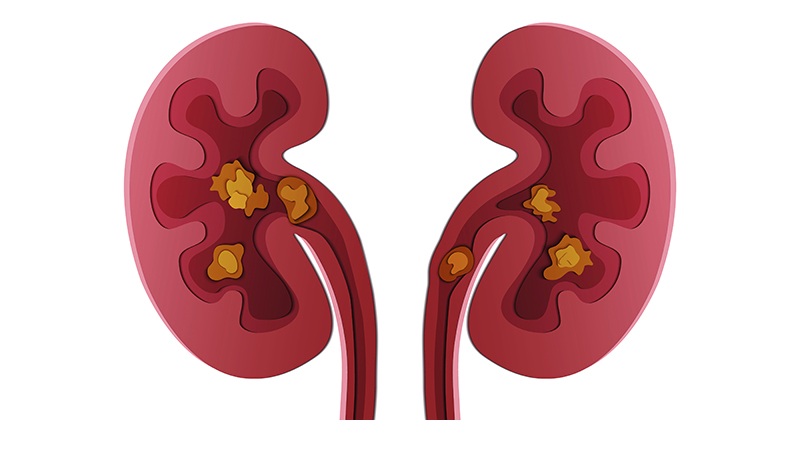 best ayurvedic medicine for kidney stone