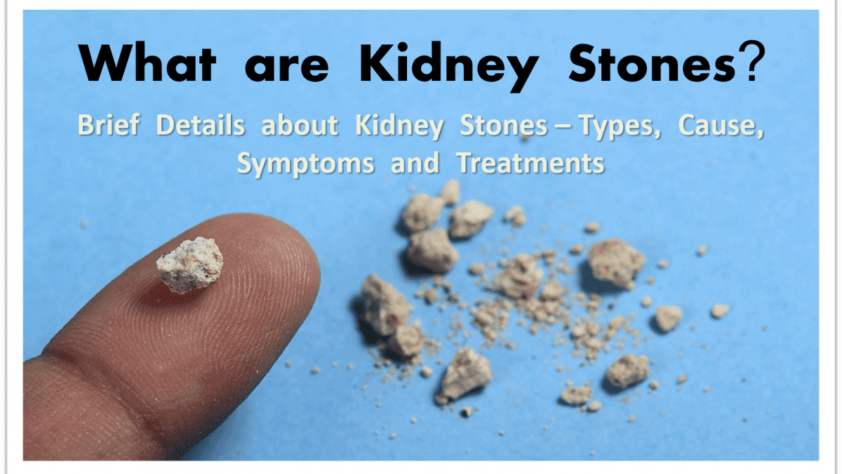 Best ayurvedic treatment for kidney stone | Karan Singh Vaidh